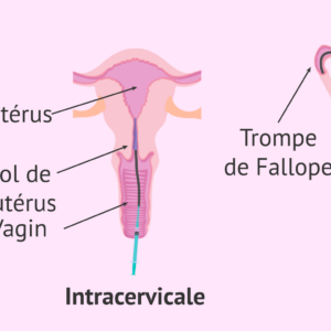 Insémination Artificielle