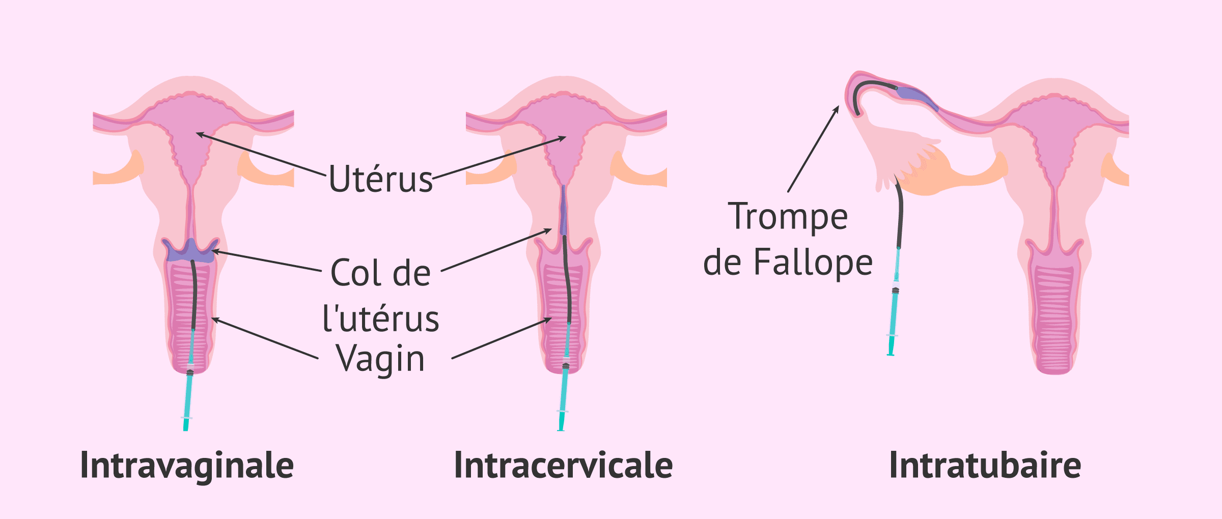 Insémination Artificielle