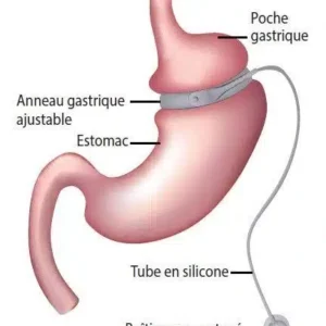 anneau gastrique