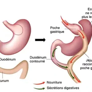 bypass gastrique