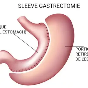 sleeve gastrique