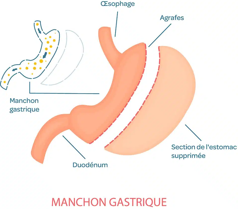 sleeve gastrique en tunisie