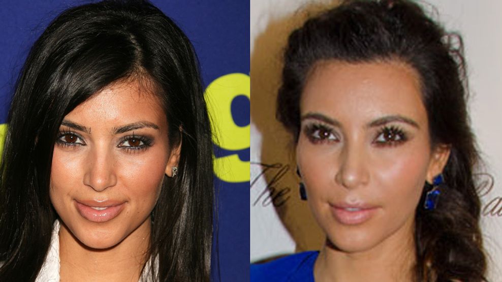 kim kardashian chirurgie esthetique